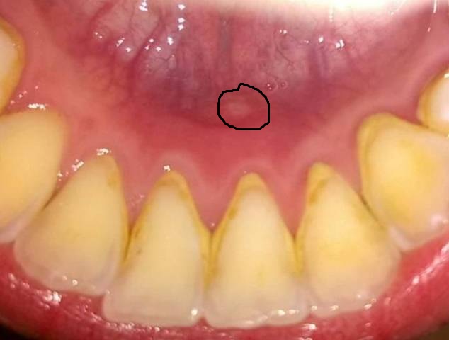 Hạt mụn trắng ở giữa lưỡi và hàm dưới