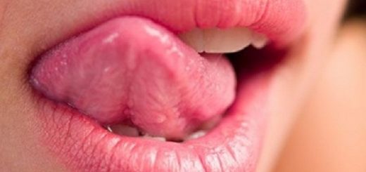 Xuất hiện mụn trắng ở lưỡi, khó ăn uống và sinh hoạt