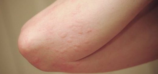 Muỗi cắn khiến da bị mẩn ngứa và lan rộng