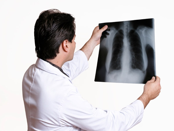 Dấu hiệu nhận biết ung thư phổi