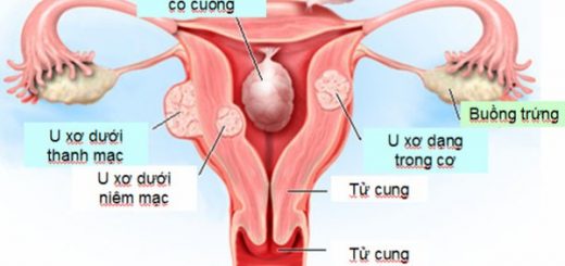 Khi mổ u xơ tử cung có phải cắt tử cung?