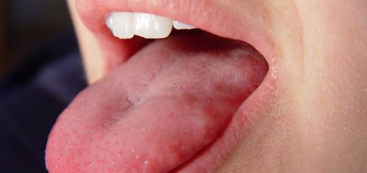 Phát hiện lưỡi có màu xanh đen là bệnh gì?
