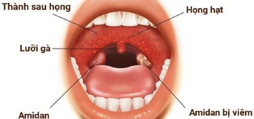 Cách chữa hoàn toàn bệnh viêm họng hạt mãn tính?