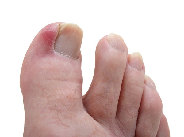 Ngón chân bị sưng và tụ mủ có nguy hiểm?