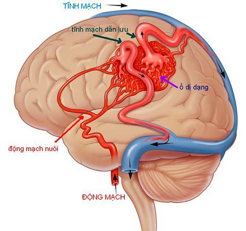 Tại sao bị dị dạng mạch máu não?