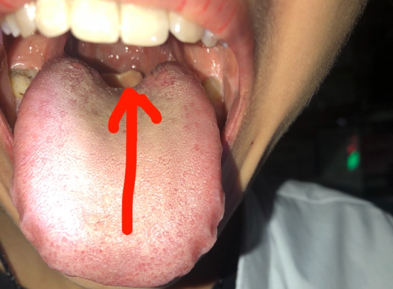 Xuất hiện cục màu trắng ở cuống lưỡi là bệnh gì?