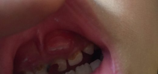 Cách điều chỉnh răng mọc sai vị trí ở trẻ?