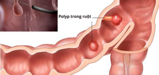 Bị Polyp đại tràng u tuyến ống nghịch sản độ thấp có nguy hiểm?
