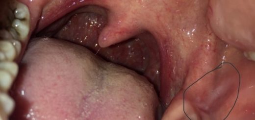 Trong miệng có đốm trắng là bệnh gì?