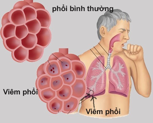 Bị bệnh viêm phổi có dễ tái phát không?