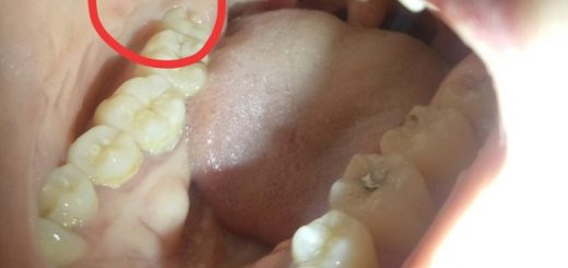 Trong miệng nổi hạt đỏ li ti là bệnh gì?