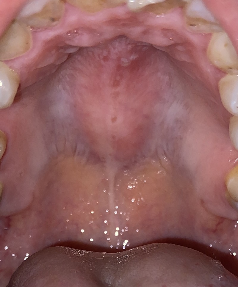 Chai bề mặt vòm miệng, viêm họng là bệnh gì?